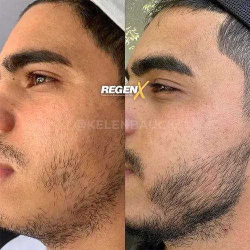 RegenX Barba (3)