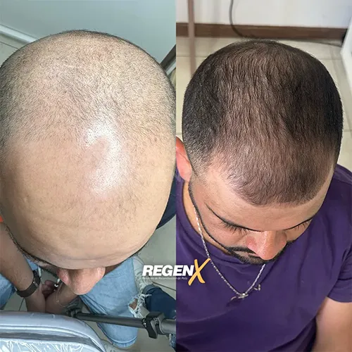 RegenX Cabelo (1)