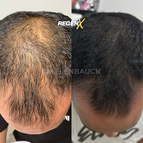 RegenX Cabelo (6)