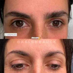 33-FEED-SOBRANCELHA-Resultado-de-procedimento-r7ls44jvuak9guelj3xf2fbyl1kh5l115y31vb5lls